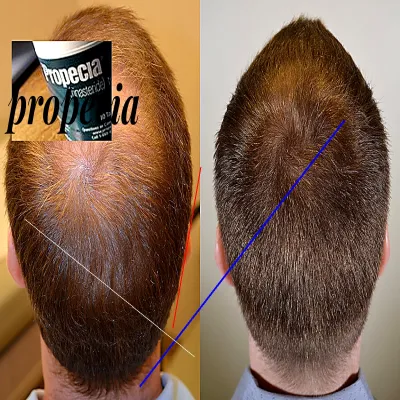 Propecia finasteride générique